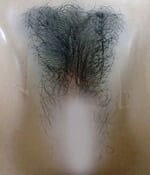 images, pubic hair implant